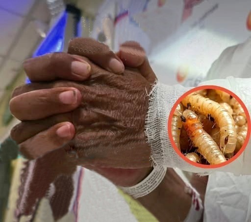 Hospital Escuela reporta 51 pacientes recuperados de Miasis Humana en 2025 gracias a atención médica oportuna

 